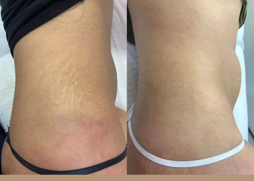 Areola Tattoo Treatment, Scalp Micropigmentation Or Cheek Blush Tattoo