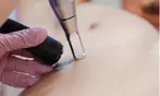 Experience Laser By Nicole - Fort Lauderdale with three tattoo removal treatments for various area sizes up to 37% off