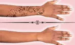 Enjoy Three Precision Laser Sessions for Tattoo Removal