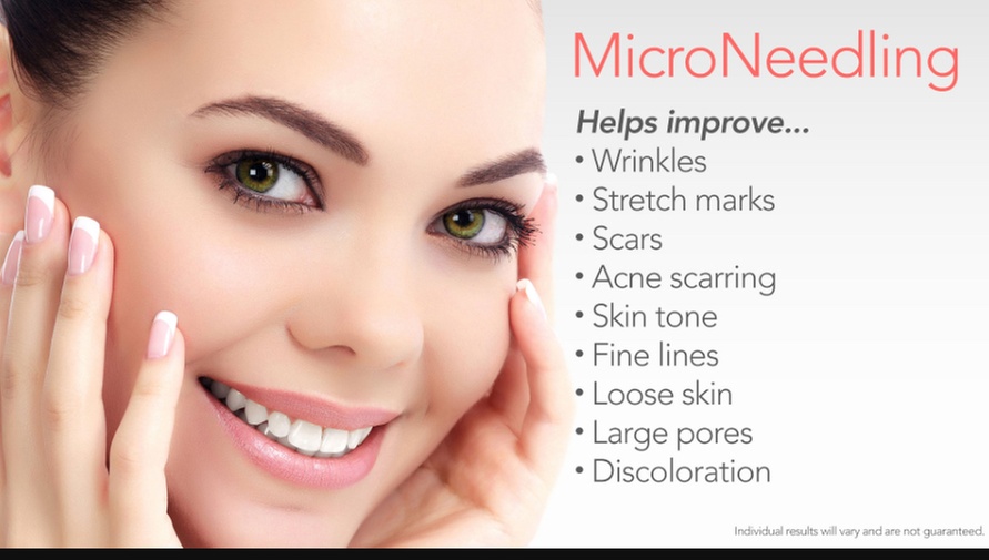 Up to 70% Off on Vampire Facelift at OC Aesthetics Spa