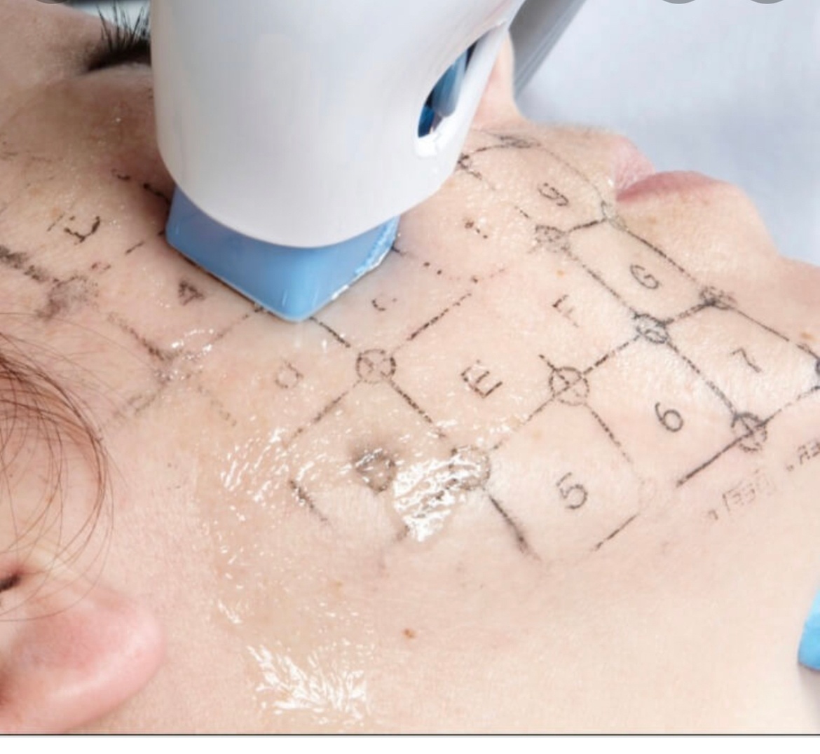Radio Frequency Skin Tightening for a Youthful Look
