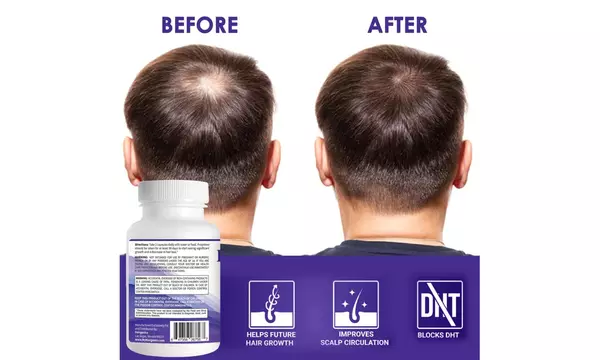 Propidren by HairGenics - DHT Blocker with Saw Palmetto To Prevent Hair Loss - Second Medium