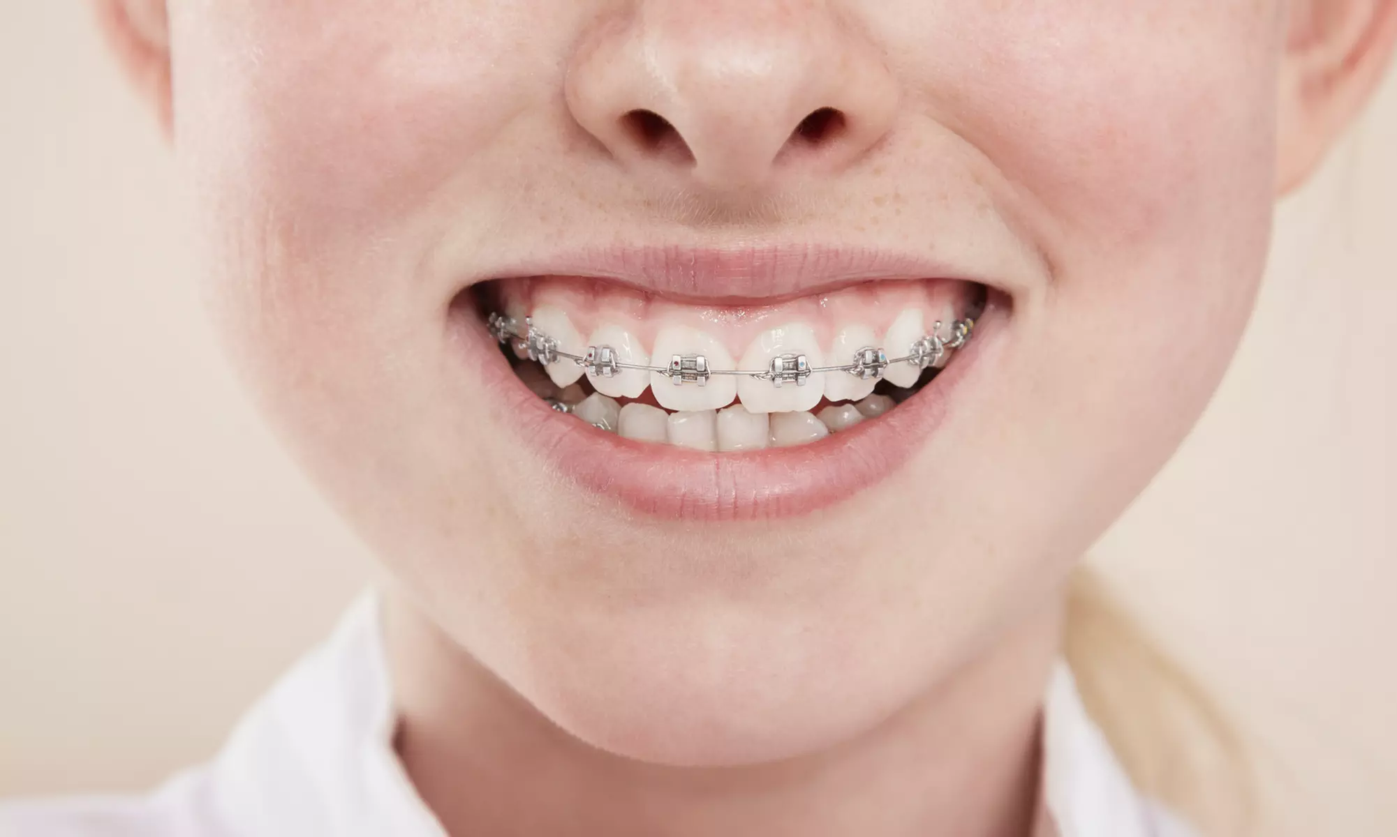 $25 for $500 Toward Traditional Braces or Invisalign - Primary Image