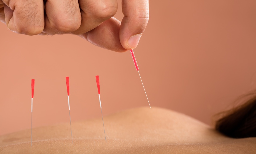 Image 1: Health Review + Acupuncture & Cupping or Gua Sha treatment with Doctor of Acupuncture at Dao Integrated Health (Up to 61% Off)