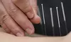 Find Relief and Restore Balance with Acupuncture Session at Iron Hands Sports & Wellness (Up to 30%Off)