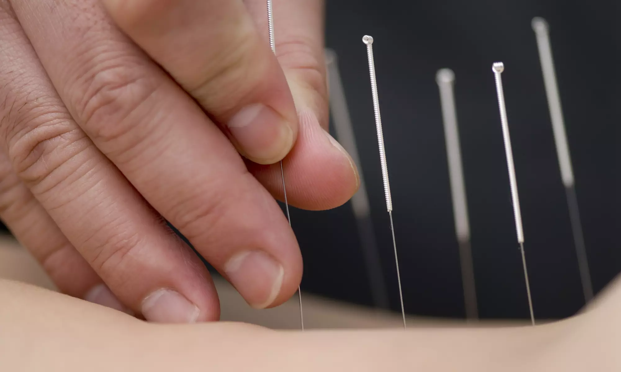 Find Relief and Restore Balance with Acupuncture Session at Iron Hands Sports & Wellness (Up to 30%Off) - Primary Image