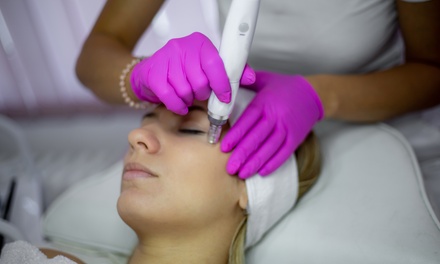 1 sesión de dermapen facial con cóctel de vitaminas - Estética Integral JNS