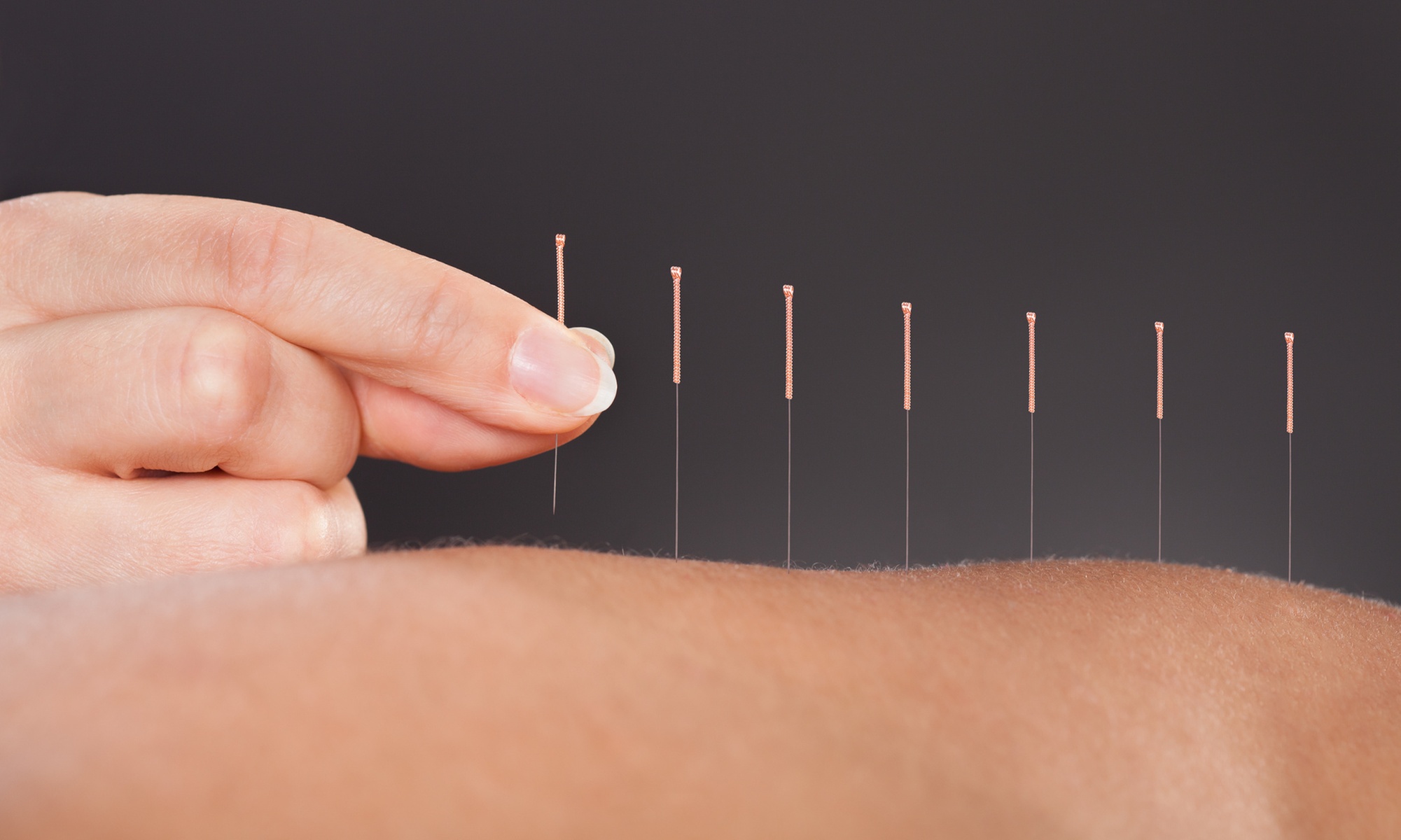 Acupuncture Sessions for Pain and Relief