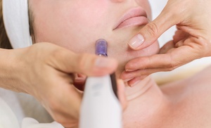 Enhance Your Beauty with Microneedling Treatment with Optional PRP Facial (Up to 81% Off) Enhance Your Beauty with Microneedling Treatment with Optional PRP Facial (Up to 81% Off)