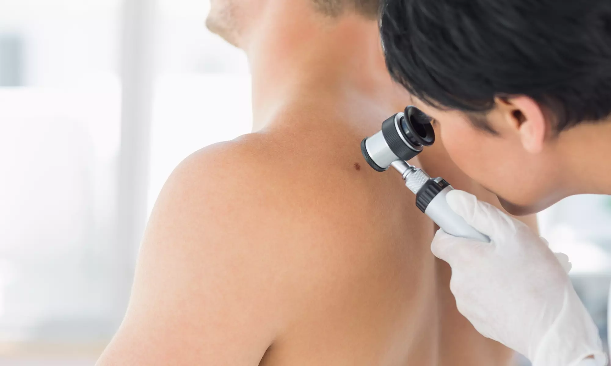 Up to 67% Off on Mole / Skin Tag Removal at Neo Derm