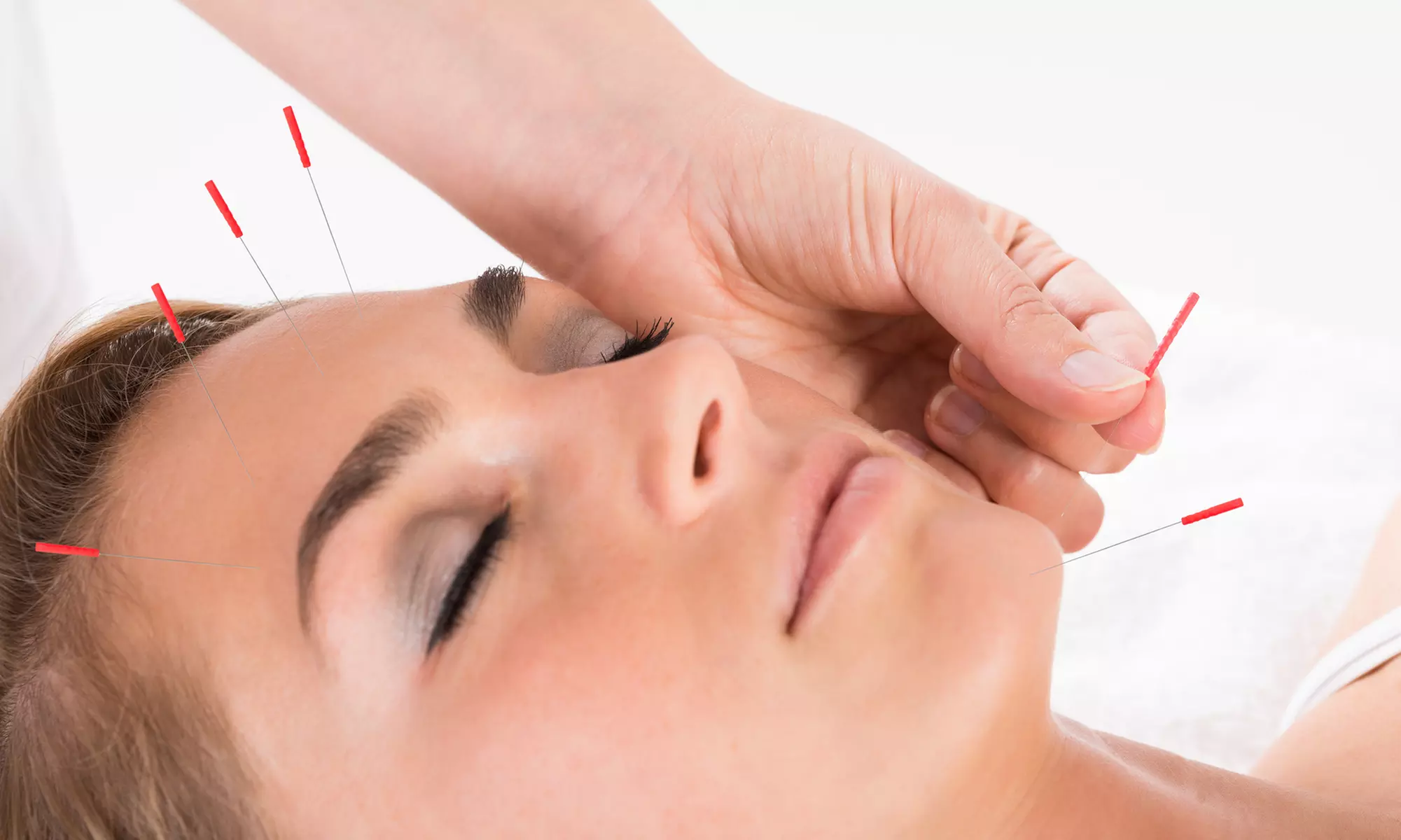 Up to 55% Off on One Acupuncture and Initial Consultation or Cupping Session at ACA Acupuncture and Wellness - Primary Image