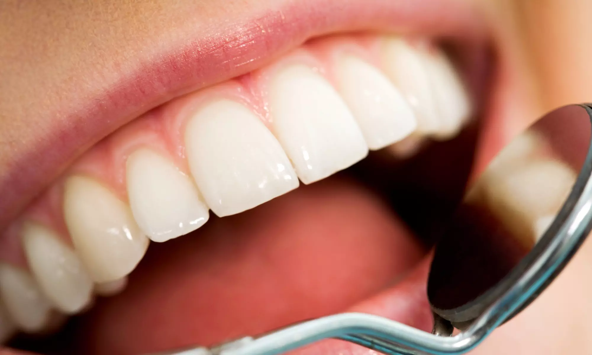 Up to 82% Off on Dental Checkup (Cleaning, X-Ray, Exam) at Santa Clarita Smile Design - Primary Image