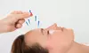 Experience The Healing Benefits Of Acupuncture at Cedros Natural Health Center(Up To 44% Off)