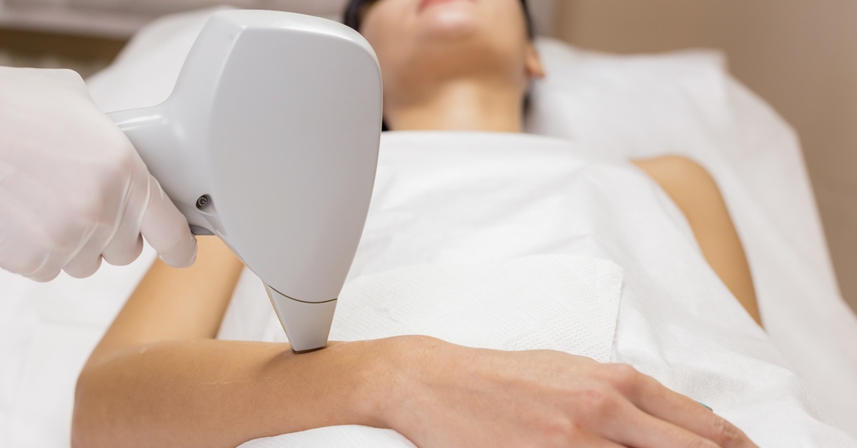 Six Sessions of IPL Laser Hair Removal on One Small Area 