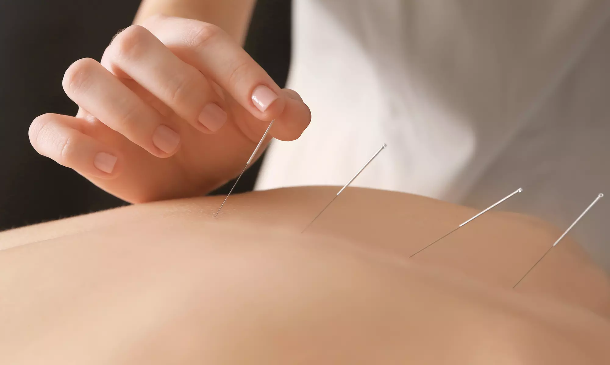 $29 for One 60-Minute Private Acupuncture Session at Naperville Acupuncture Center ($65 Value) - Primary Image