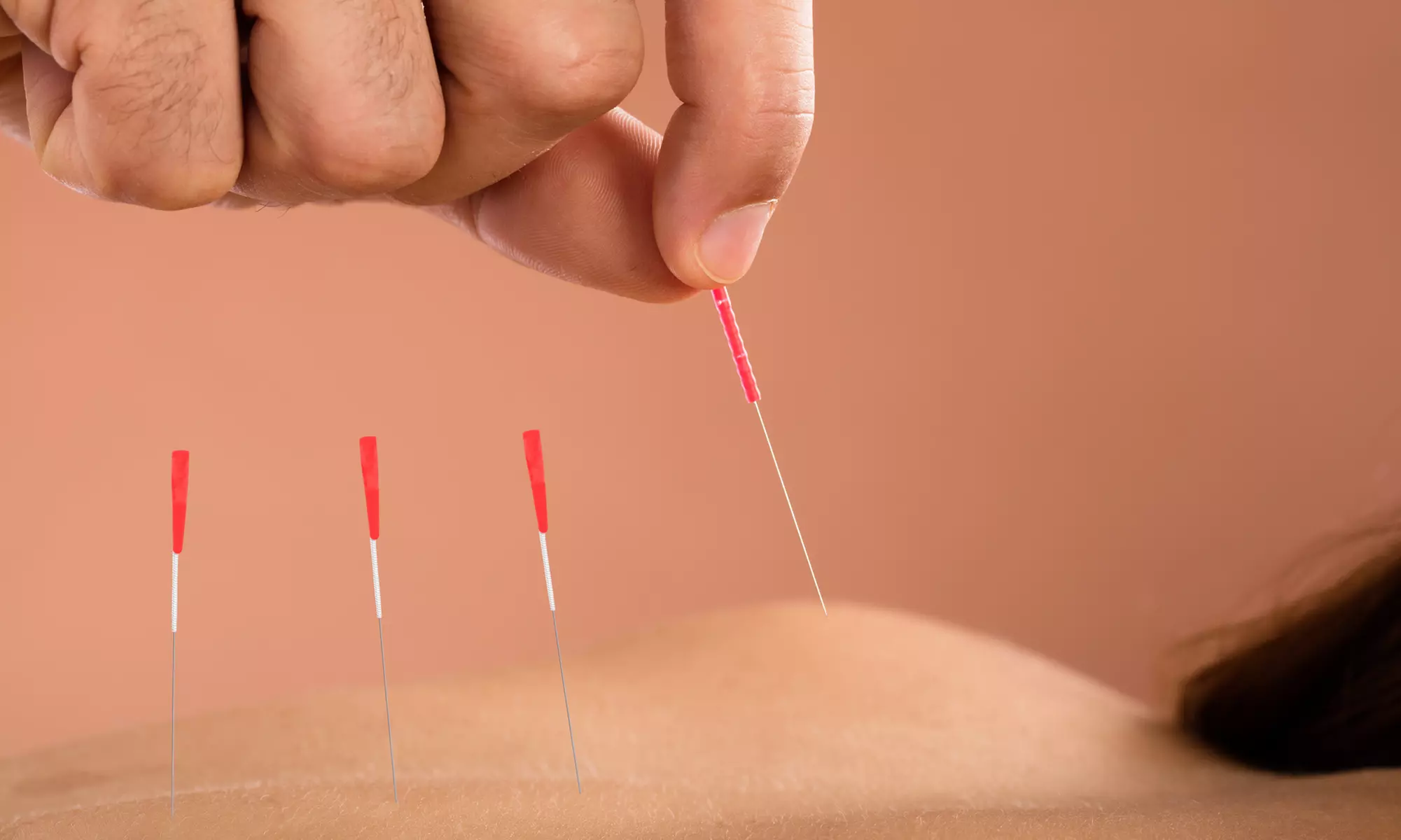 One or Two Acupuncture Sessions with TCM Assessment at Acupuncture Yang Zhang (Up to 41% Off) - Primary Image