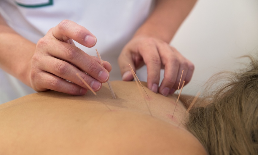 Image 1: Discover balance with One or Three acupuncture sessions