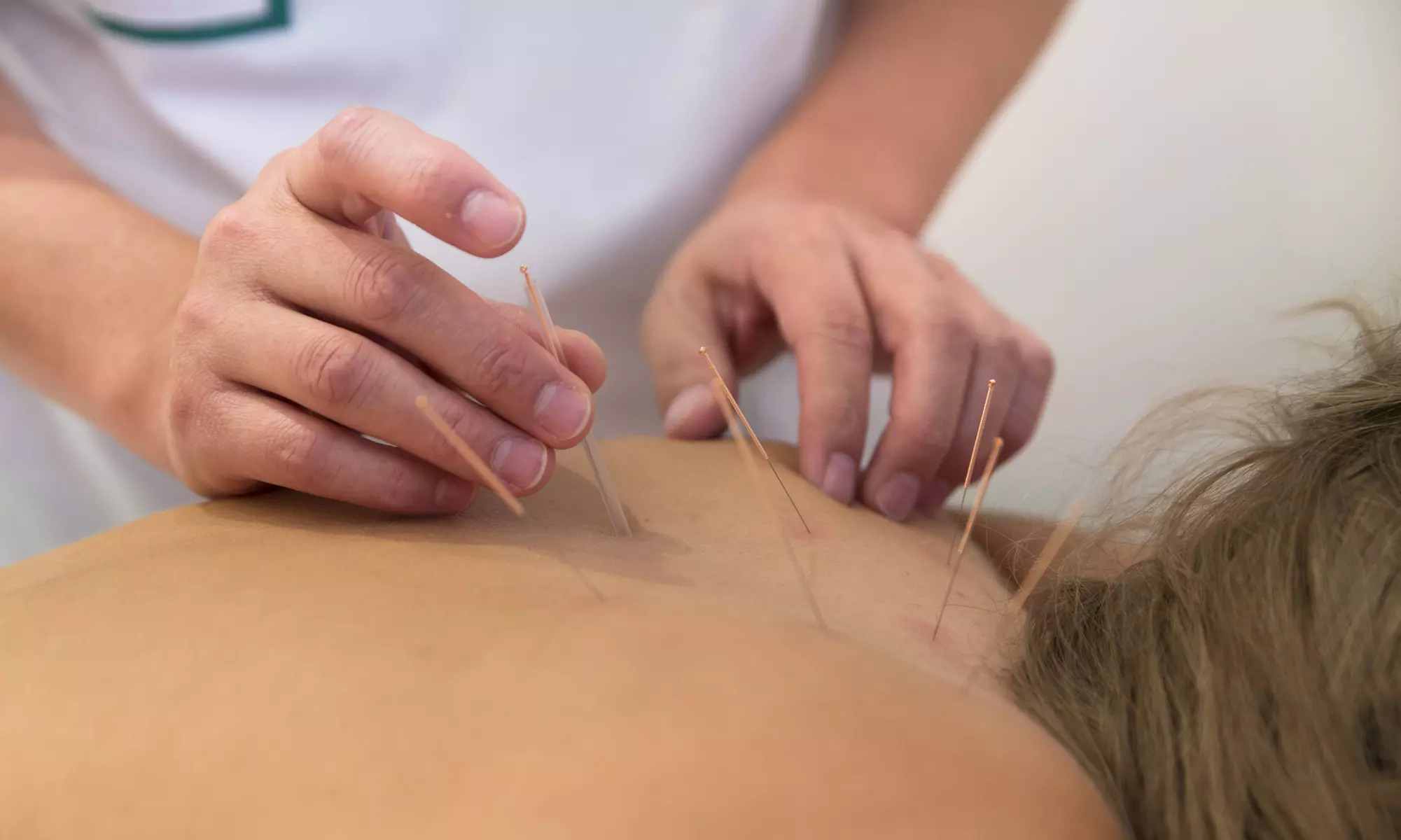 Unlock relaxation with One or Three acupuncture sessions @Acu Life Holistic Health (Up to 53% Off) - Primary Image