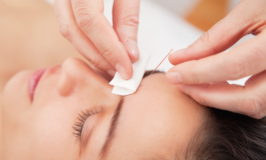 Image 1: Acupuncture sessions for stress, anxiety, or digestion relief