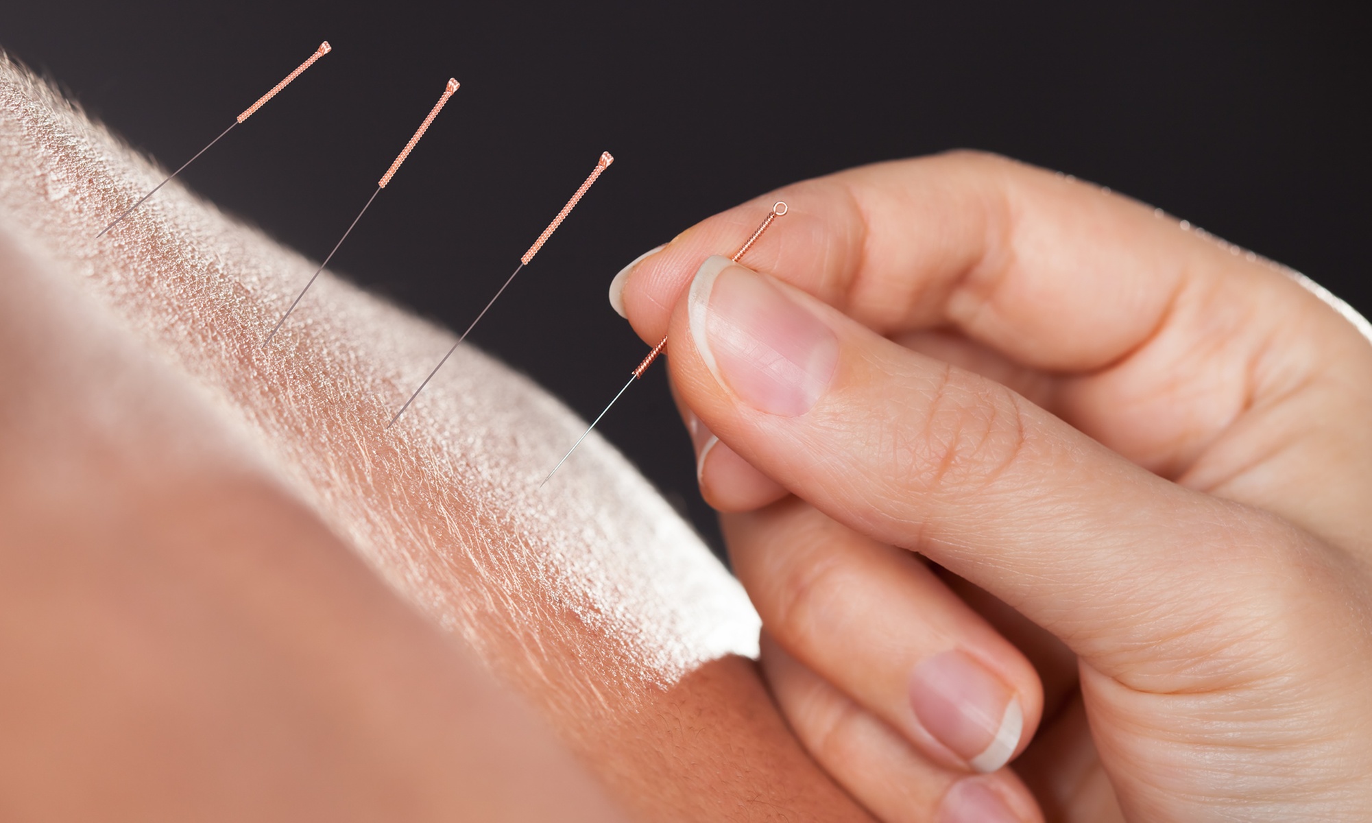 Up to 43% Off on Acupuncture at MediLotus Acupuncture and Herbs