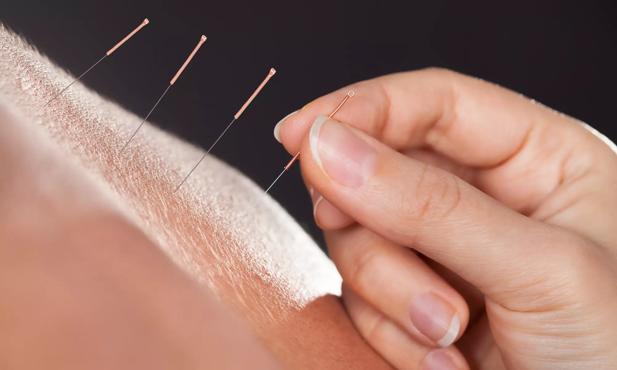 Up to 37% Off on Acupuncture at MediLotus Acupuncture and Herbs - Primary Image