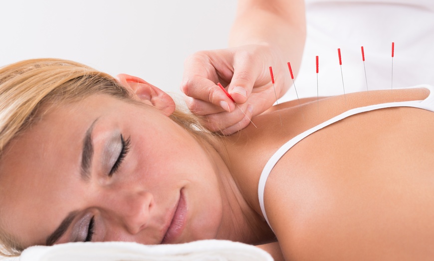 Image 1: 45-Minute Acupuncture Session