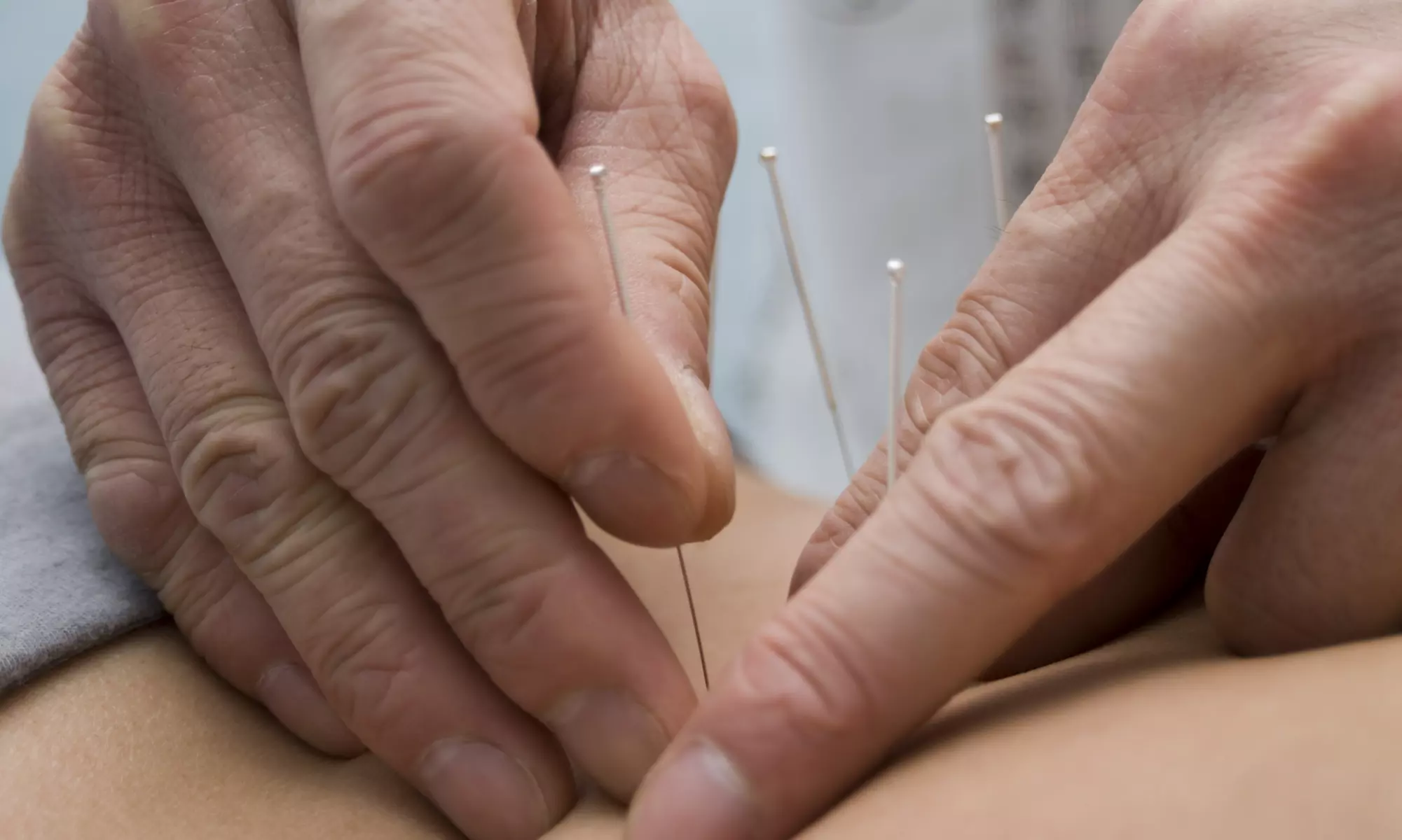 Potomac Acuclinic: One-Hour Consultation & Electro Acupuncture for Ultimate Muscle Relief! (Up to 50% Off) - Primary Image