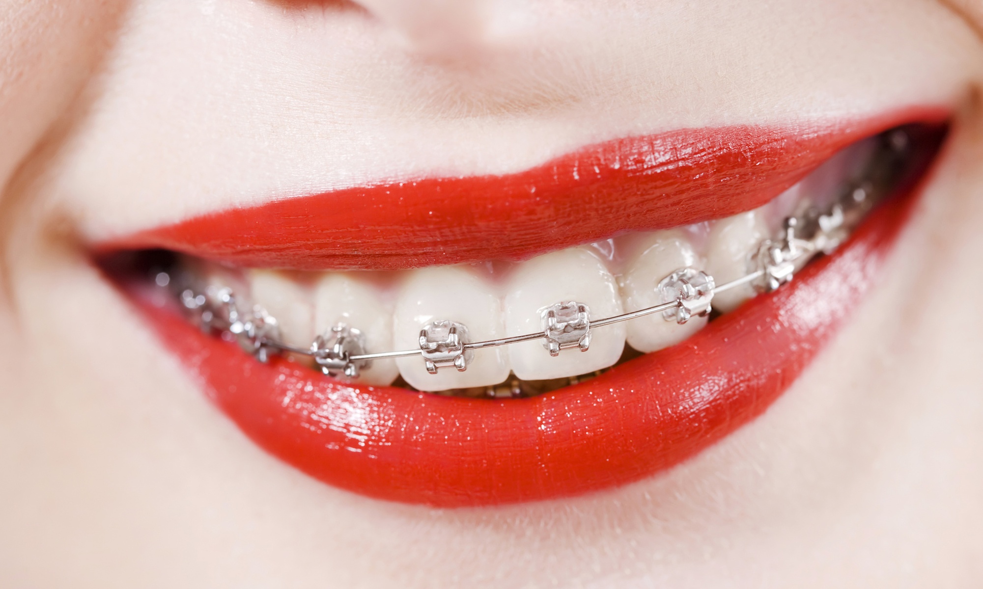 Transform your Smile with Metal/ceramic Braces One or Two Arch Fitting