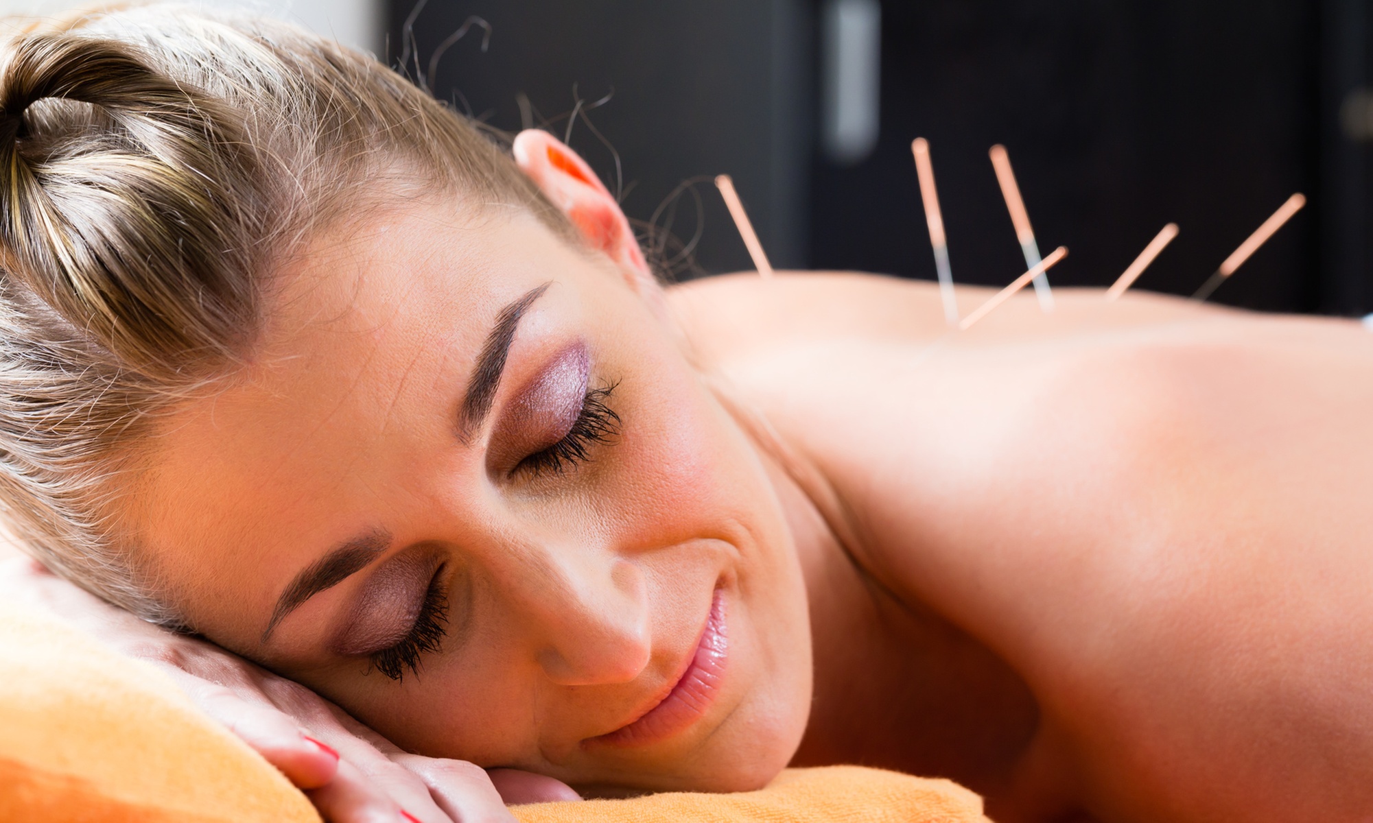 Unlock Your Zen: Experience the Magic of Acupuncture and Fire Cupping! 