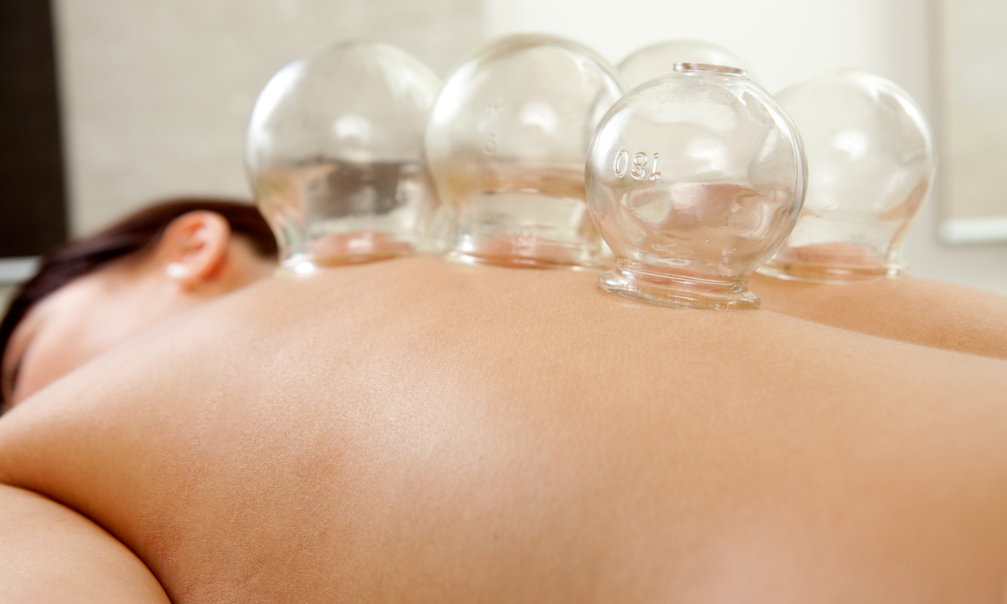 Acupuncture & Cupping Sessions for Relaxation and Healing