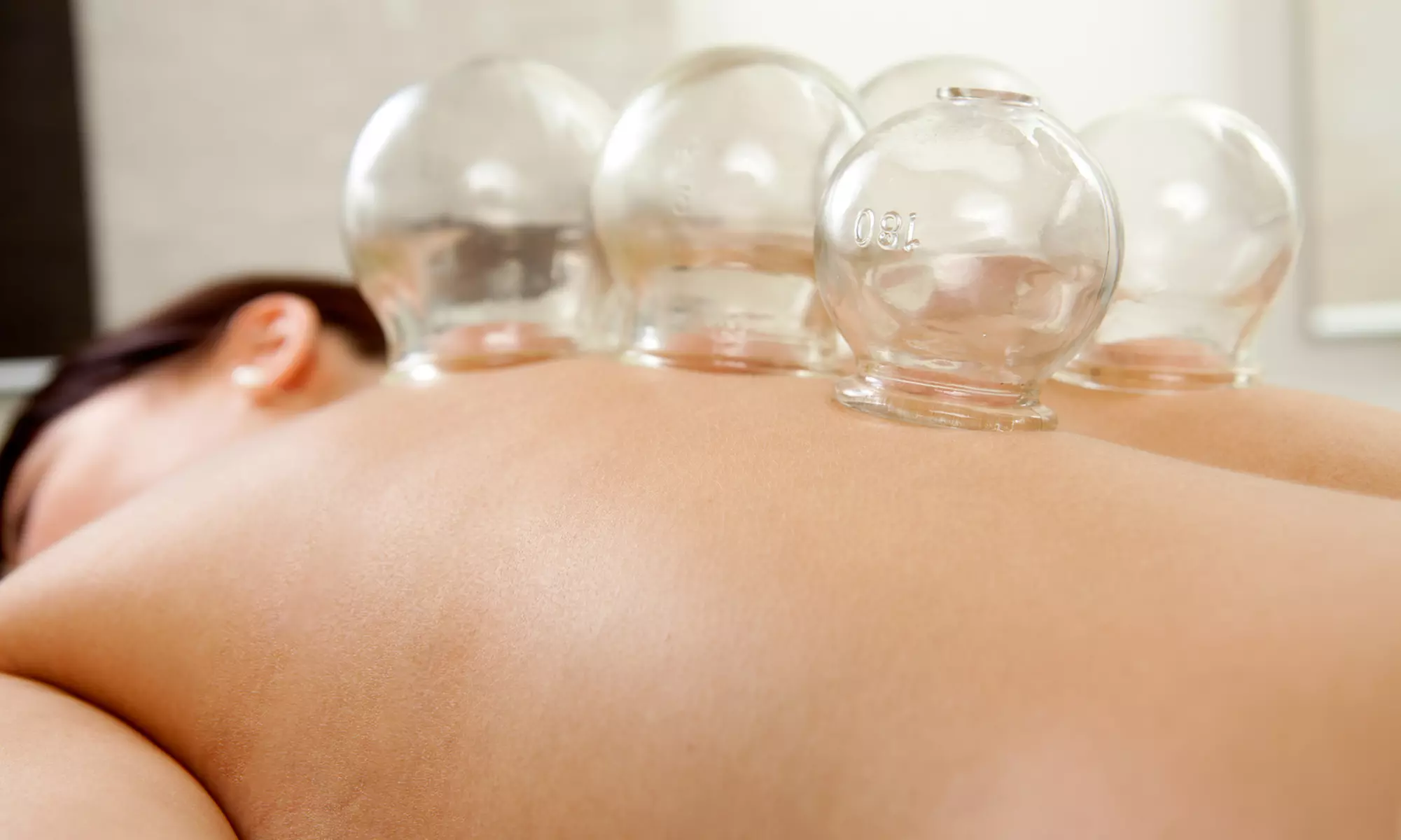 Acupuncture & Cupping Sessions for Relaxation and Healing