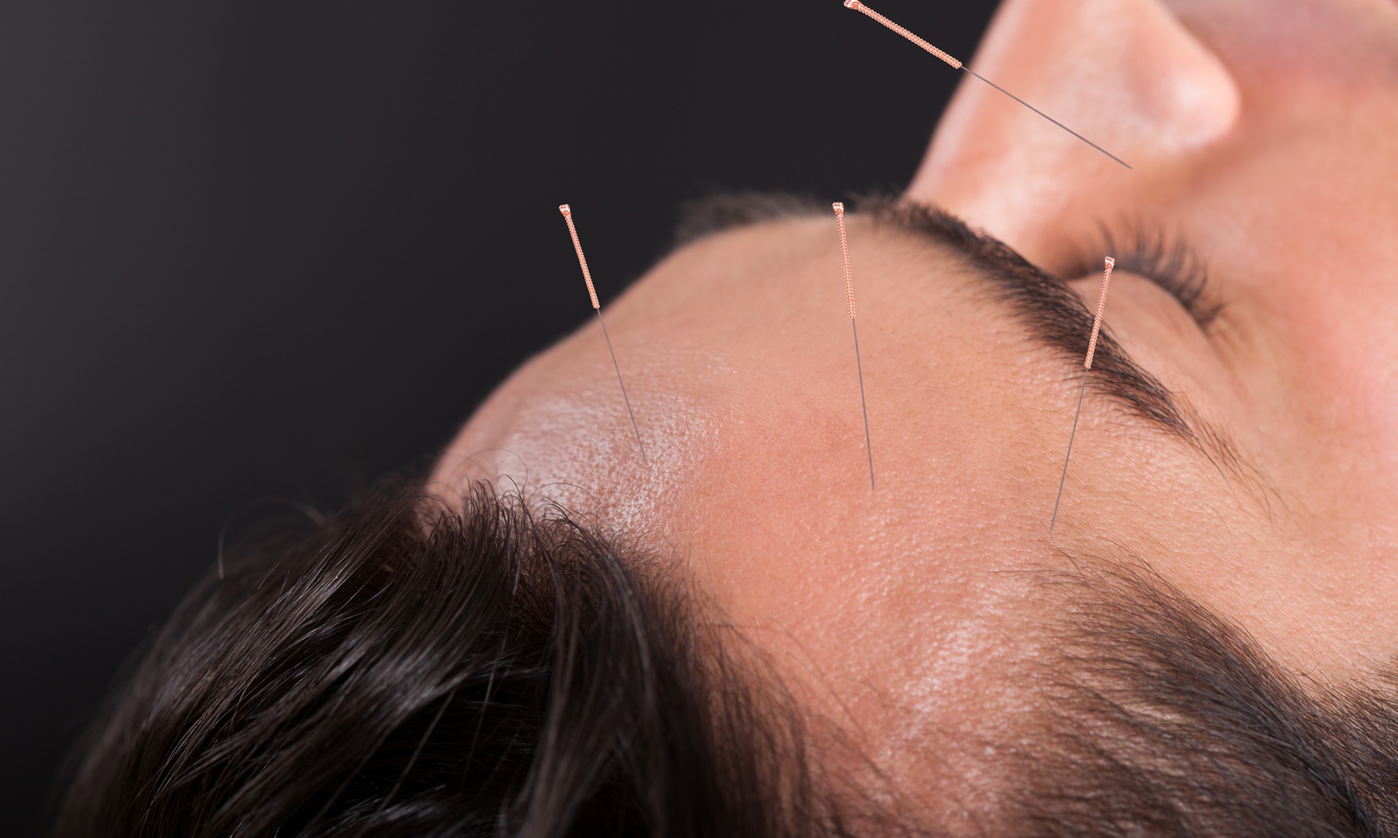 Relax w/ 1 or 2 Acupuncture Sessions with Optional Add Ons Treatment