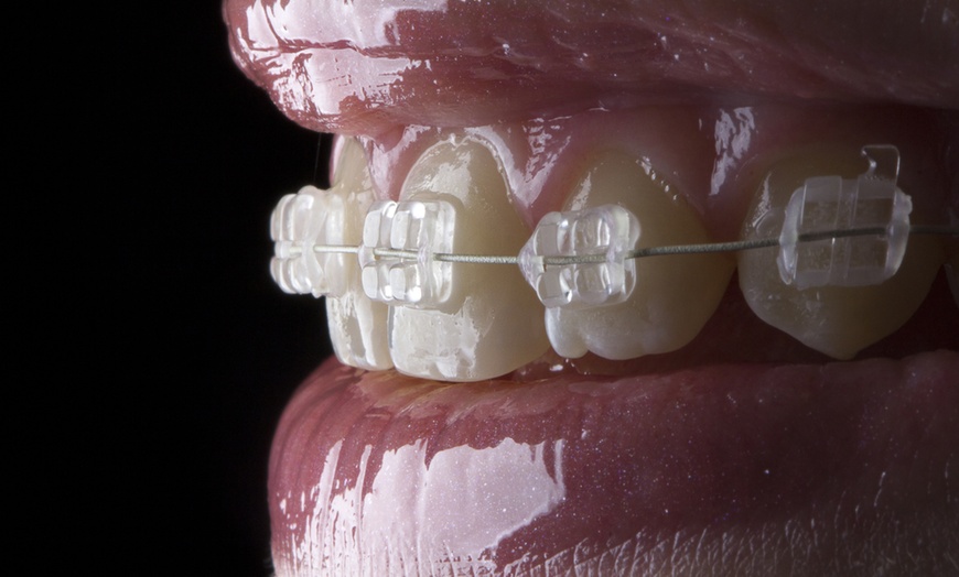 Image 1: Tratamiento de ortodoncia a elegir en Clinica dental Orthoden