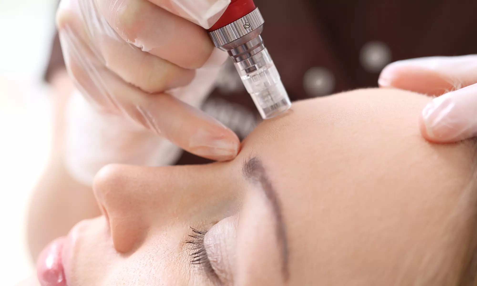 One or Three Microneedling Treatments at Ageless Rejuvenation Center (Up to 57% Off) - Primary Image