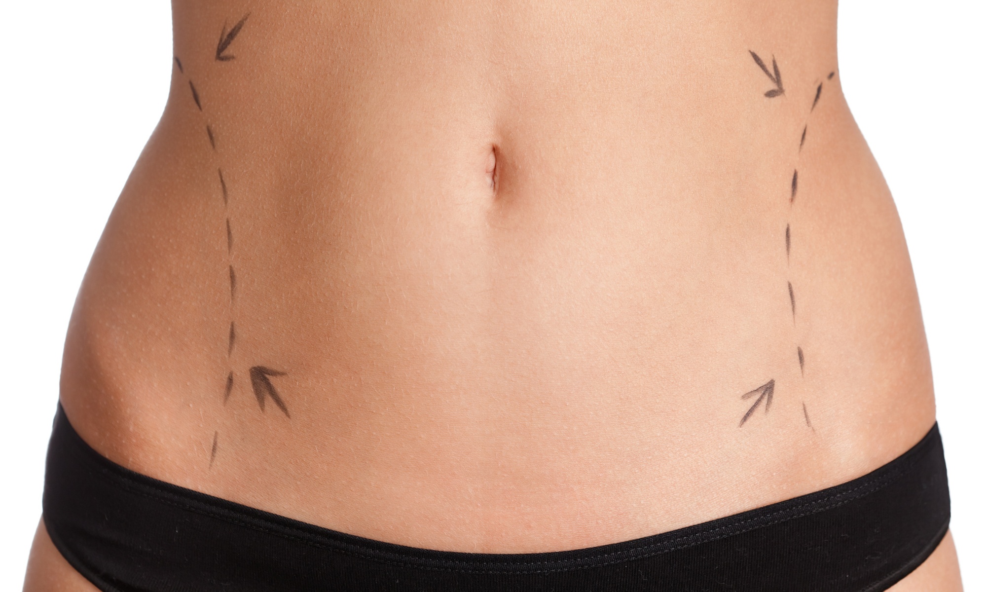 Experience non-invasive laser liposuction with up to six treatments