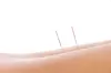 Up to 50% Off on Acupuncture at anjel Wellness