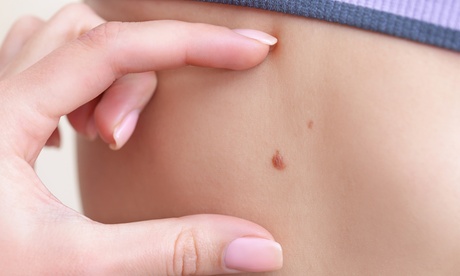 Visita dermatologica total body con videodermatoscopia digitale e mappatura dei nei (sconto fino a 64%)