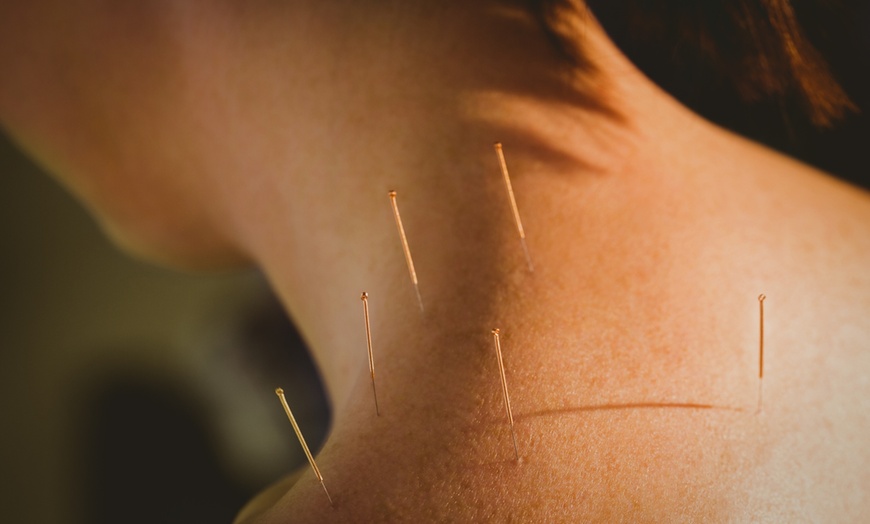 Image 1: Up to 67% Off Electro-Acupuncture Treatment at The Chicago FIX