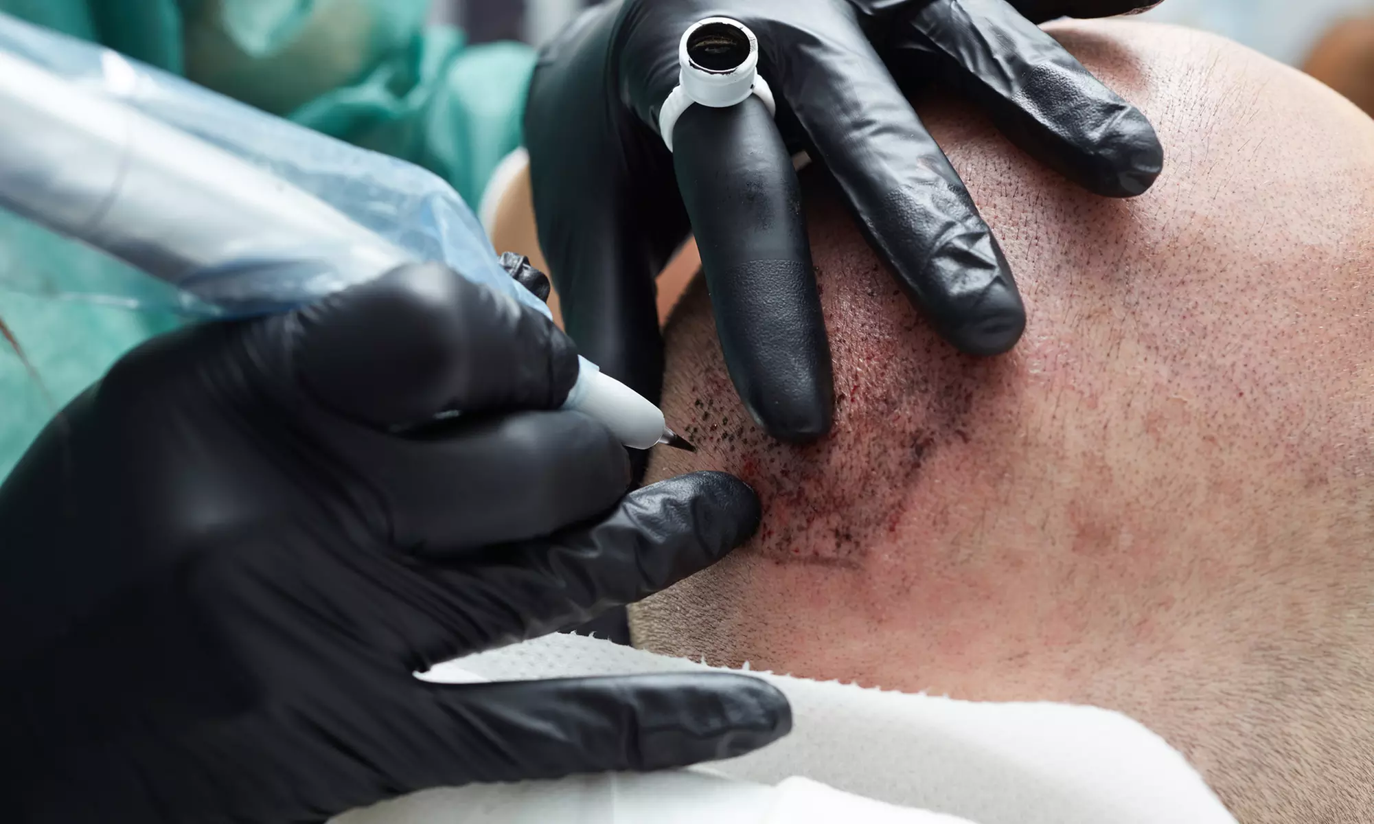 Scalp Micropigmentation Treatment at Always Young Beauty Clinic