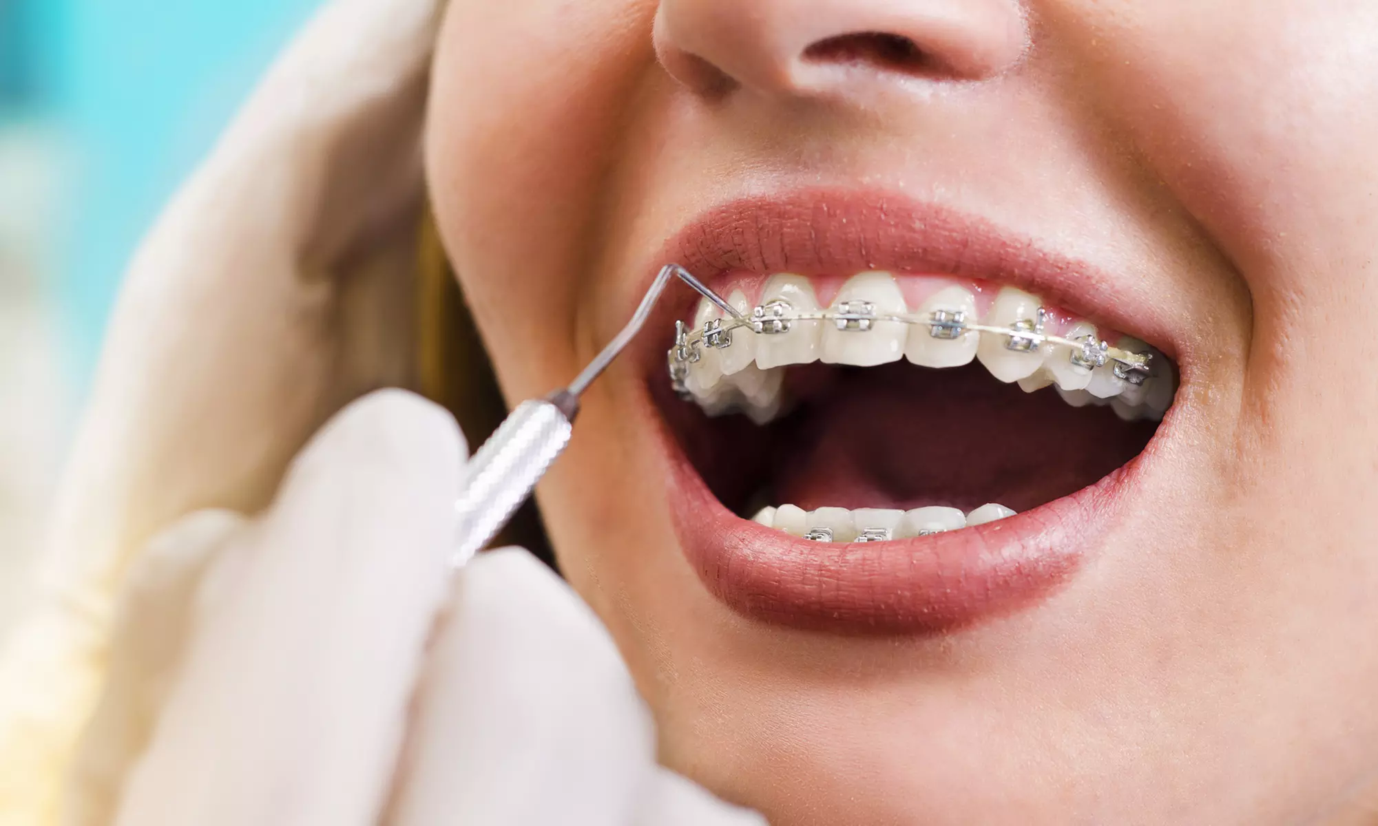 Tooth-Coloured Clear Braces at Dental Care London