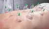 Experience Deep Relaxation with a One Cupping Session at Anjel Wellness (Up to 55% Off)