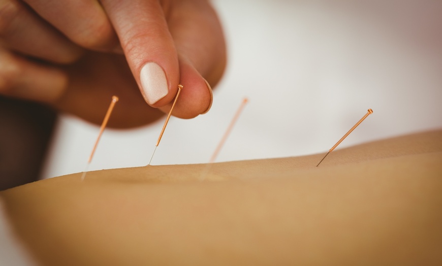 Image 1: Up to 64% Off on Acupuncture Services at G Beauty Spa