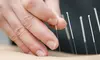 Improve w/ One, Three, or Six Acupuncture & Cupping Sessions @Trio Chiropractic & Wellness Center (Up to 86%Off)