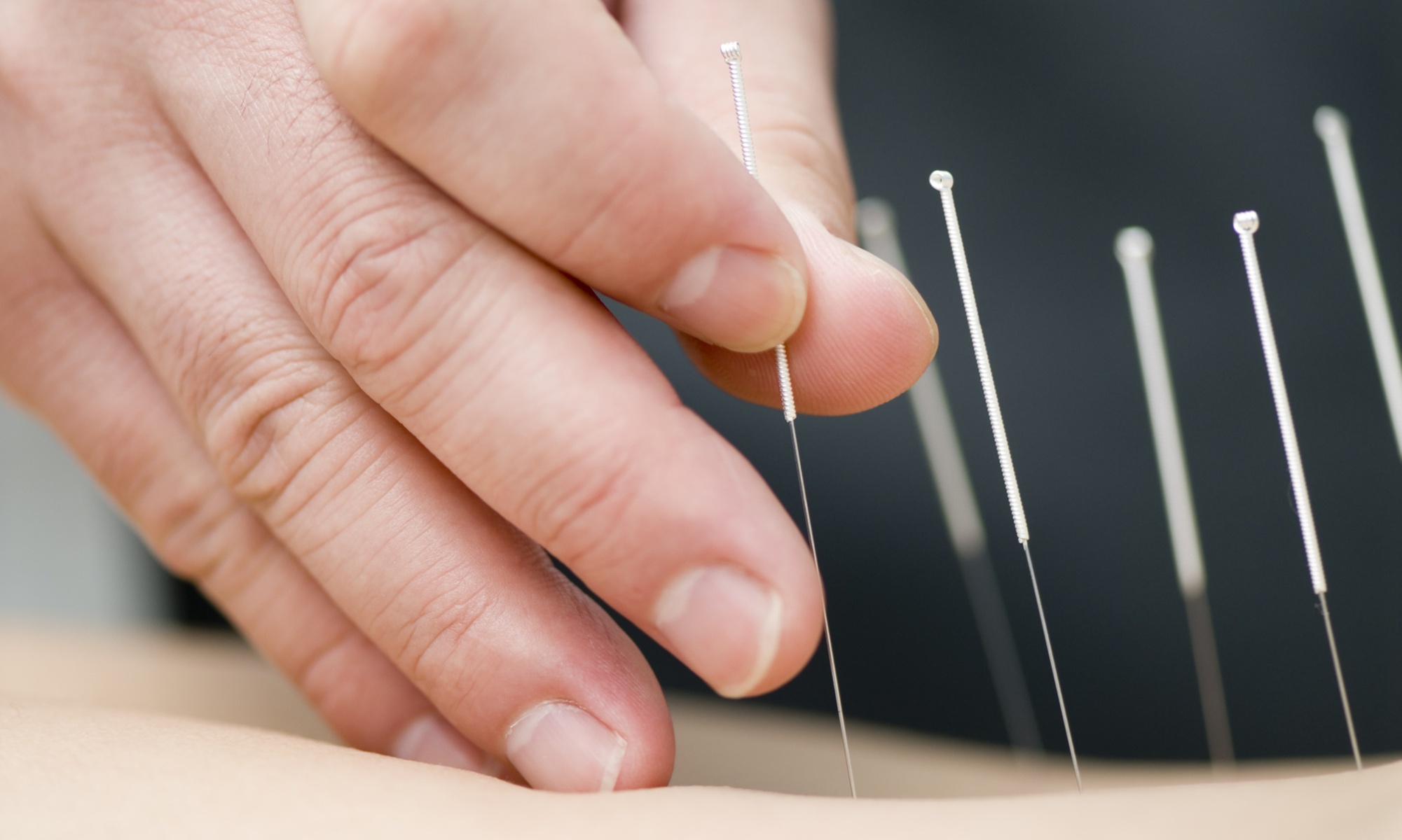 Revitalize with One, Three, or Six Acupuncture & Cupping Sessions 