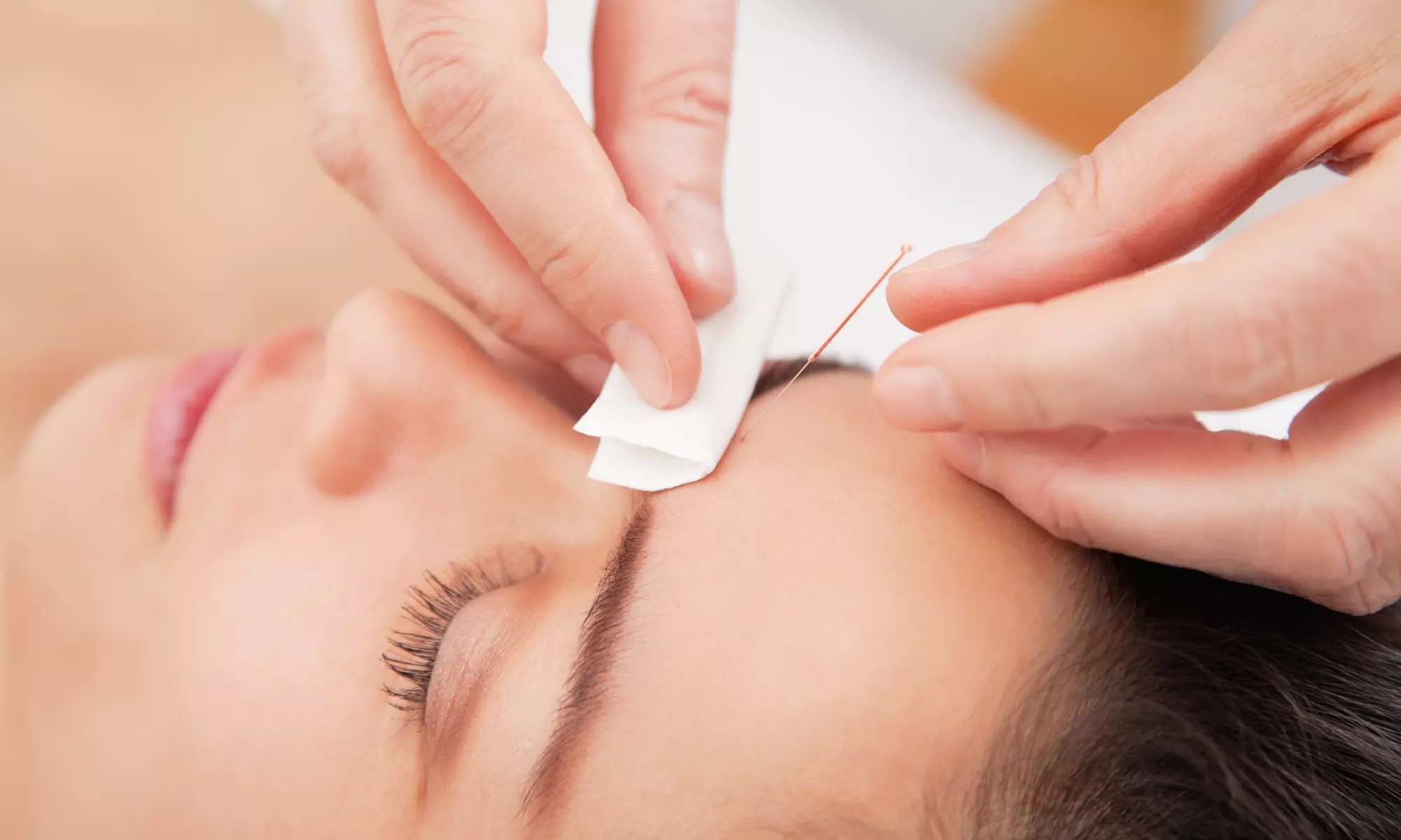 Revitalize Your Body with One Acupuncture Session at Metabolic Weight Loss Centers (Up to 55%Off) - Primary Image