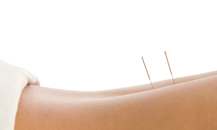 Image 1: Acupuncture with Optional Cupping + Wellness Consultation 