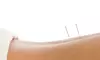 Acupuncture Session with Consultation & Optional Cupping Therapy at Rose Point Acupuncture Up To  55% Off