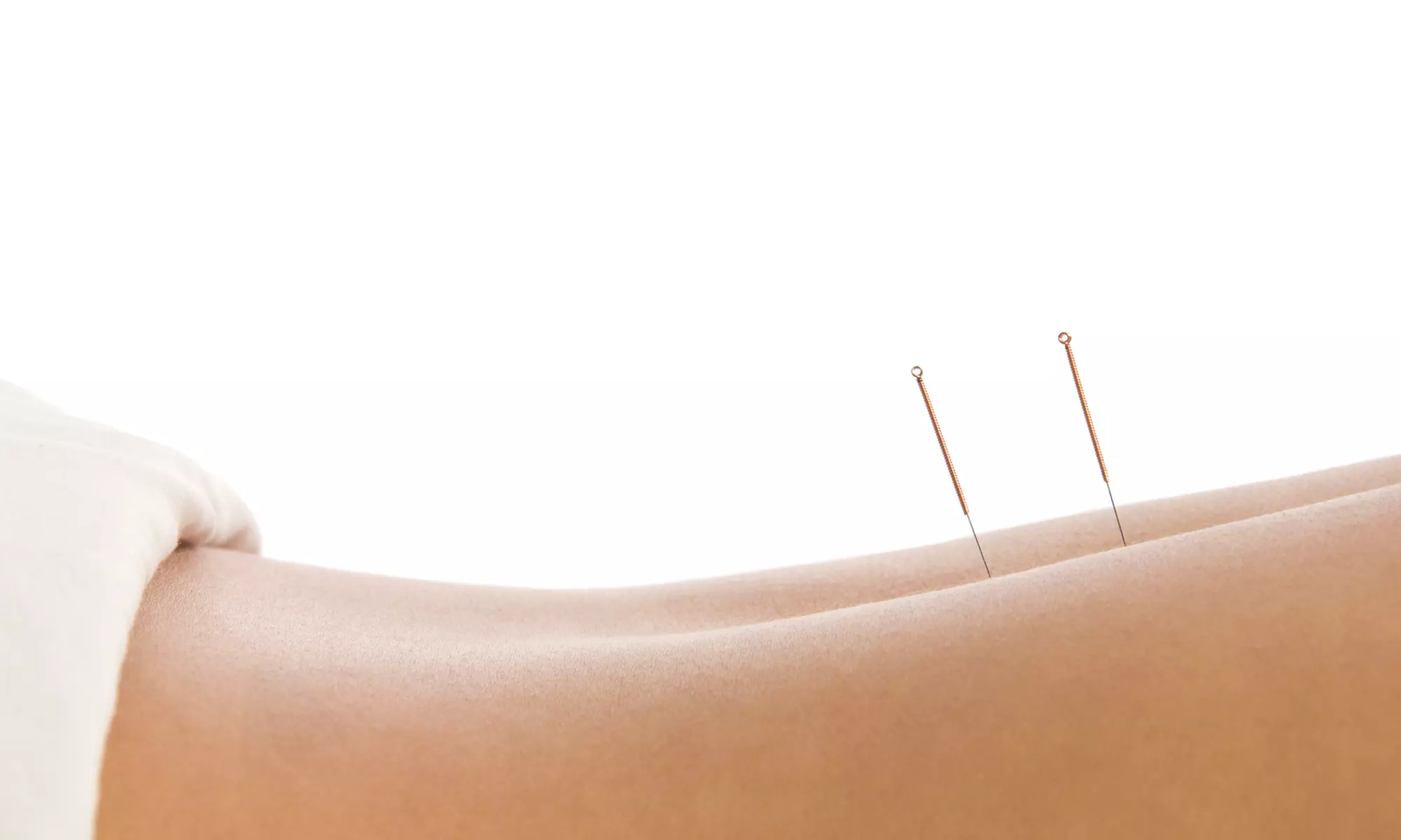 Acupuncture Session with Consultation & Optional Cupping Therapy at Rose Point Acupuncture Up To  55% Off - Primary Image