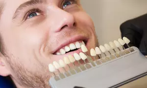 Szybkie wybielanie zębów lampą LED dla pięknego uśmiechu – oba łuki – w gabinecie Warsztat Urody