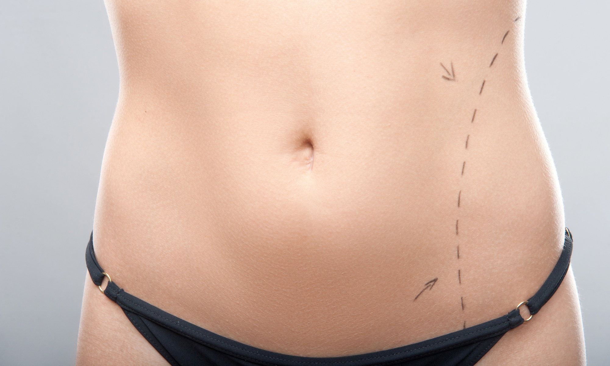 Up to 52% Off on Lipo - Non-Invasive Laser-iLipo at Two Skin and Body